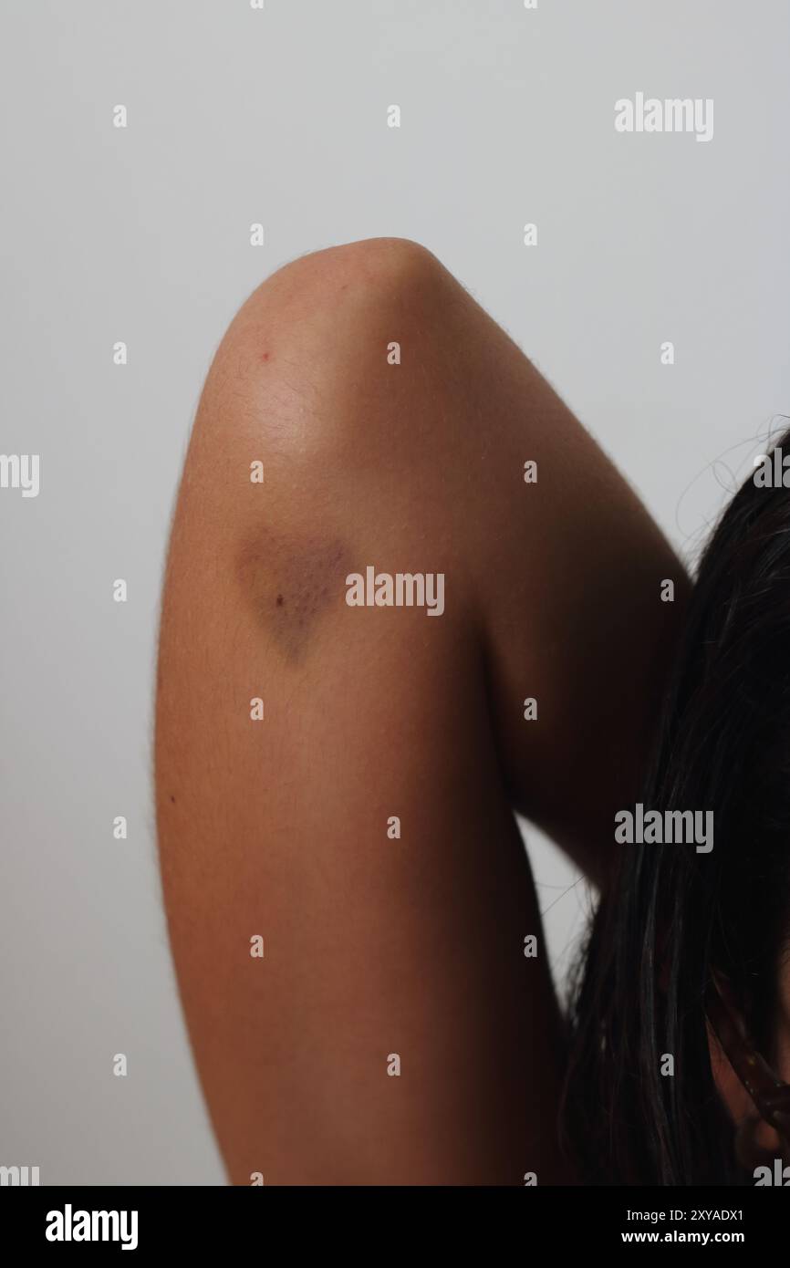 Un livido a forma di cuore sul braccio di una giovane donna simboleggia il dolore e l'impatto delle relazioni tossiche e della violenza di genere. Foto Stock