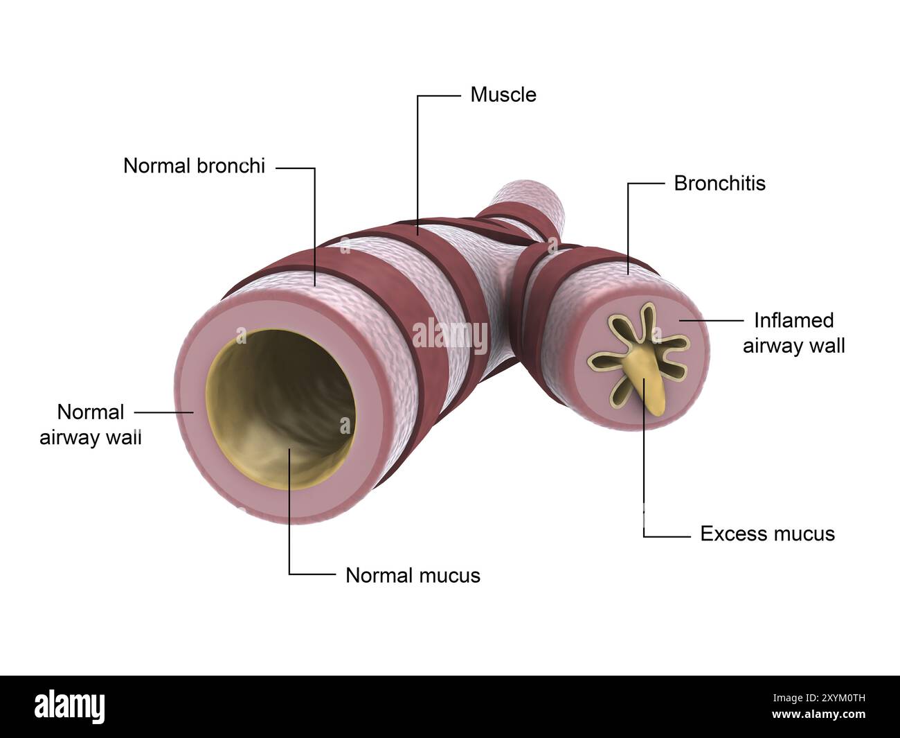 Illustrazione medica che mostra bronchite Foto Stock