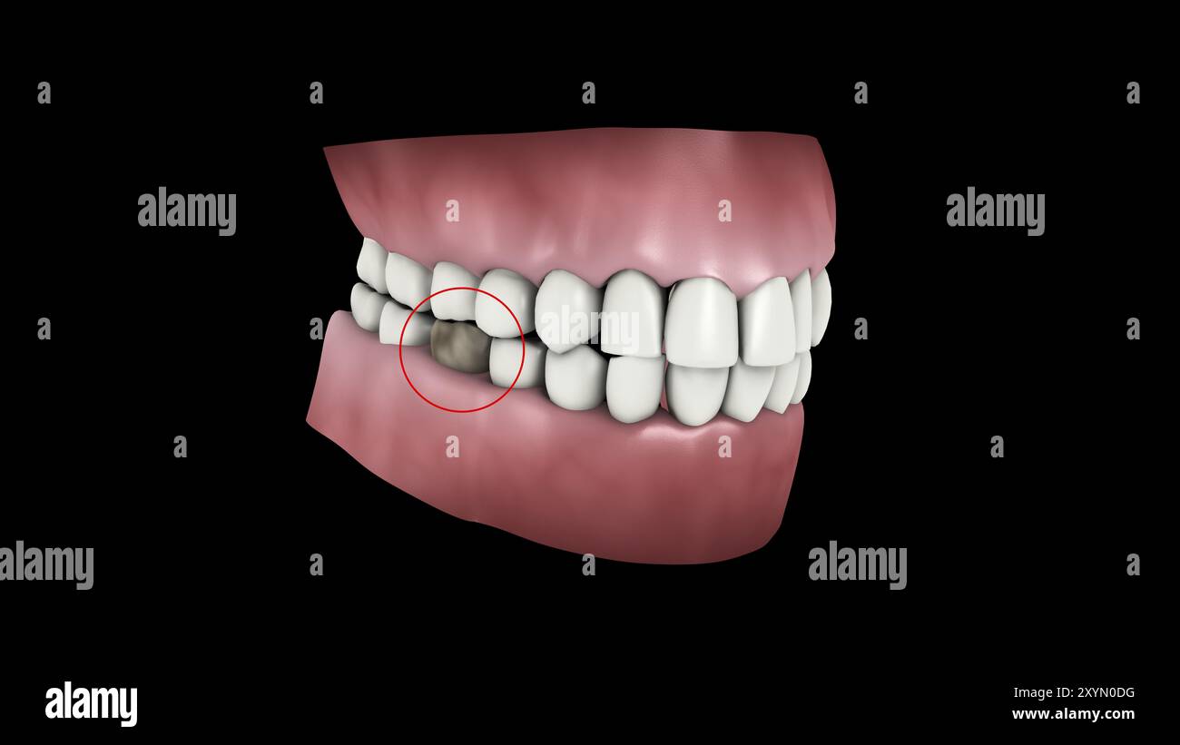 Illustrazione medica di una cavità dentale Foto Stock