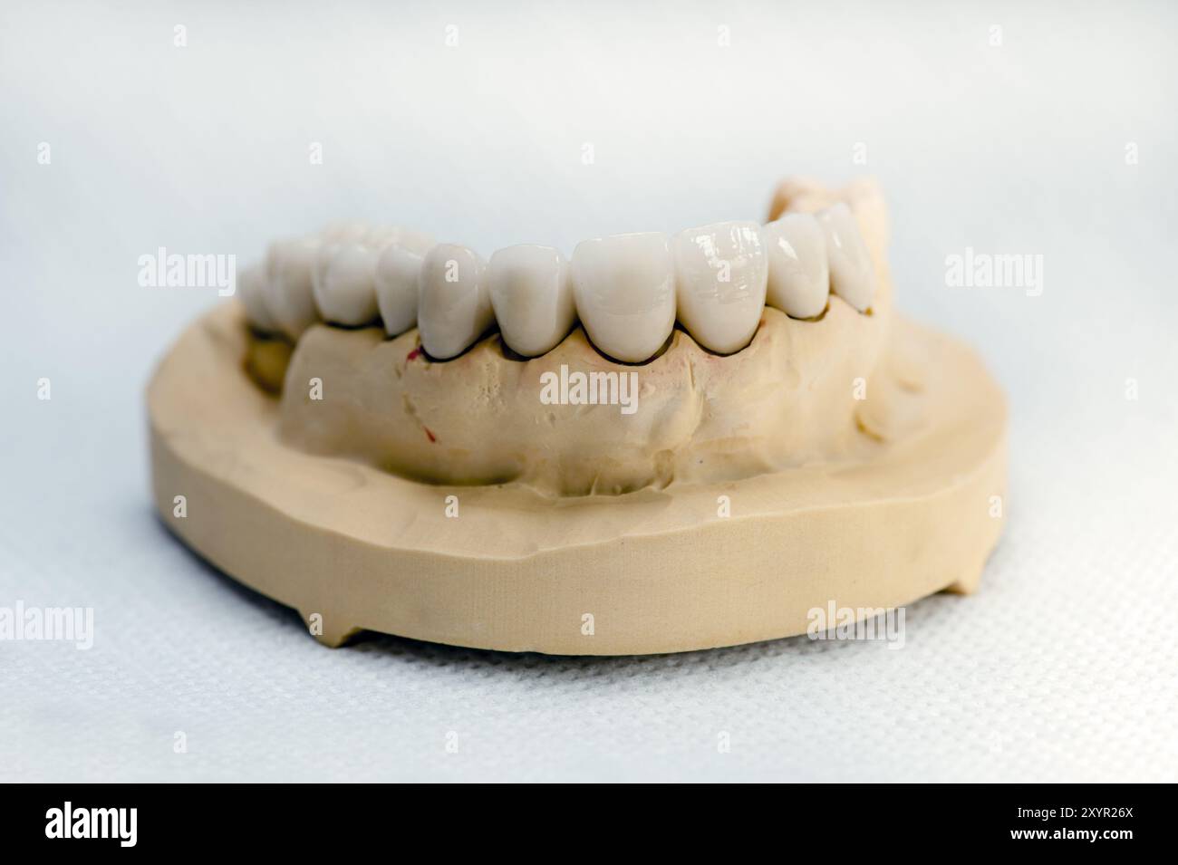 Ganascia superiore modello finito con corone in ceramica Foto Stock