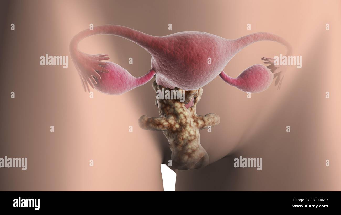 Illustrazione medica del cancro cervicale Foto Stock