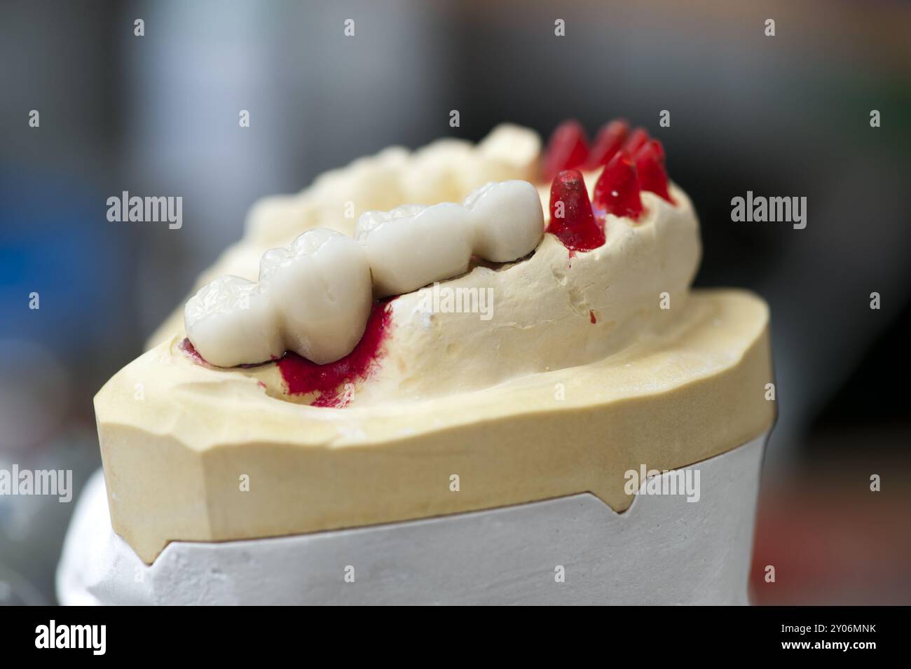 Modello a ganascia superiore con corone in ceramica attaccate Foto Stock