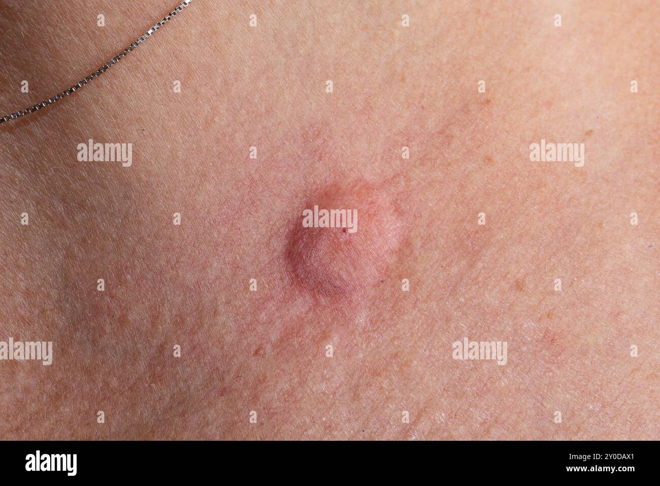 Una cicatrice keloide grande, rialzata e grintosa è prominente sul petto di una donna Foto Stock