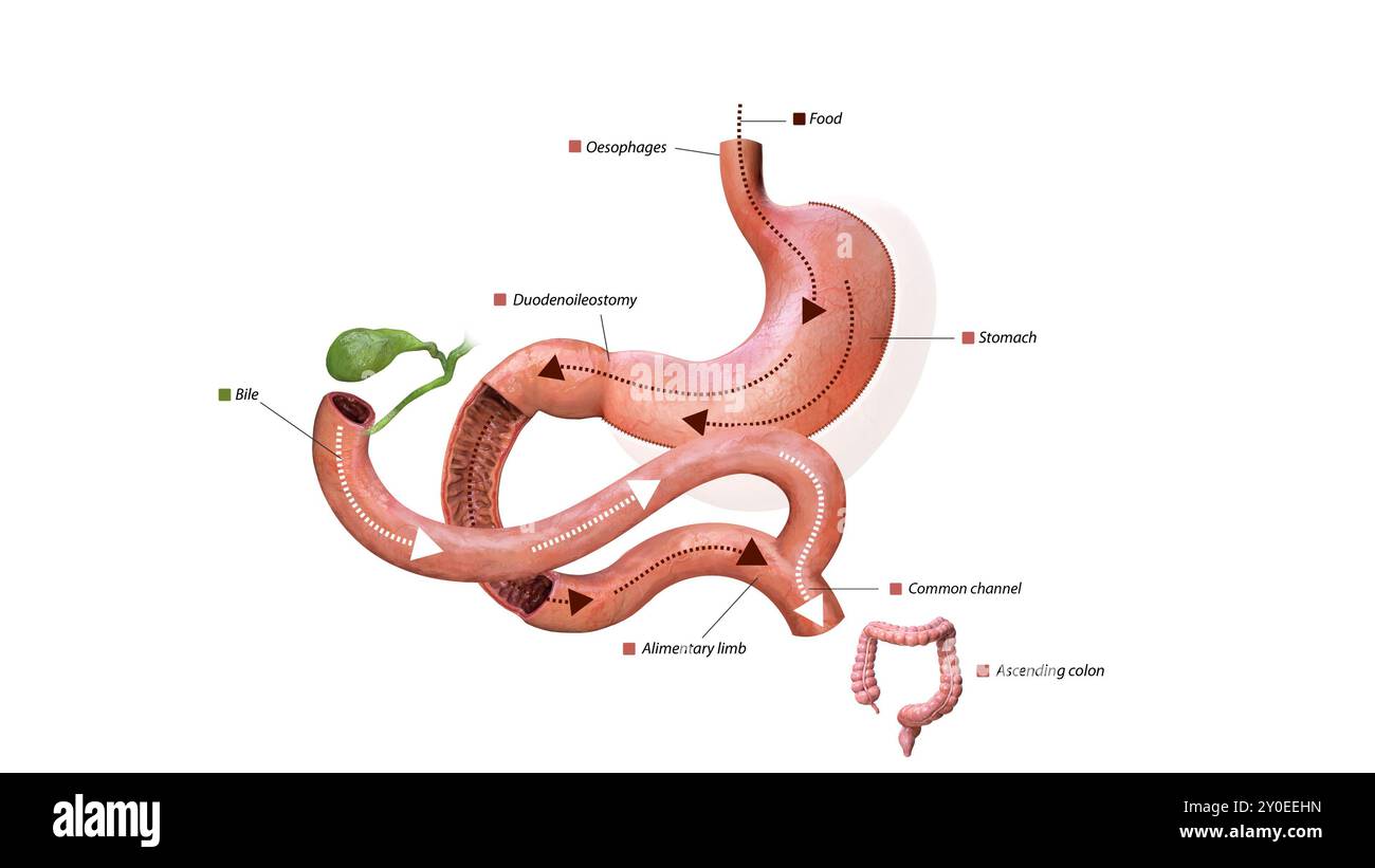 Processo digestivo dopo intervento chirurgico: Stomaco, via di somministrazione alimentare, duodenoileostomia, flusso biliare, arto alimentare, canale comune e colon ascendente, grafica 3d. Foto Stock