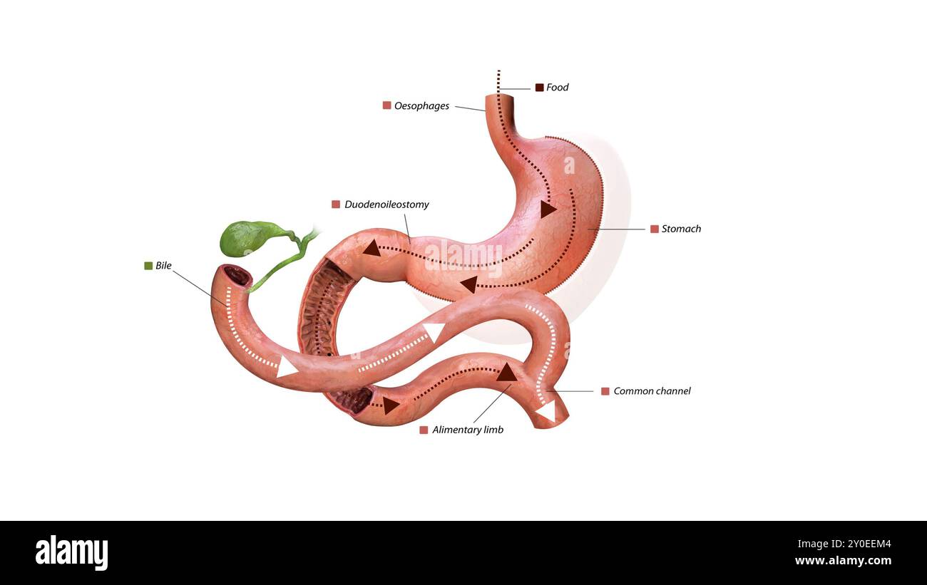 Processo digestivo dopo intervento chirurgico: Stomaco, via di somministrazione alimentare, duodenoileostomia, flusso biliare, arto alimentare, canale comune e colon ascendente, grafica 3d. Foto Stock