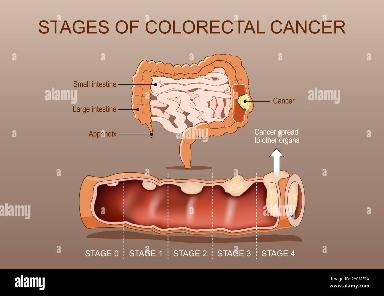 Stadi del cancro del colon-retto. Sezione trasversale dell'intestino crasso con tumore. Primo piano di un tumore maligno del colon. Poster dettagliato del vettore. Isometri Illustrazione Vettoriale