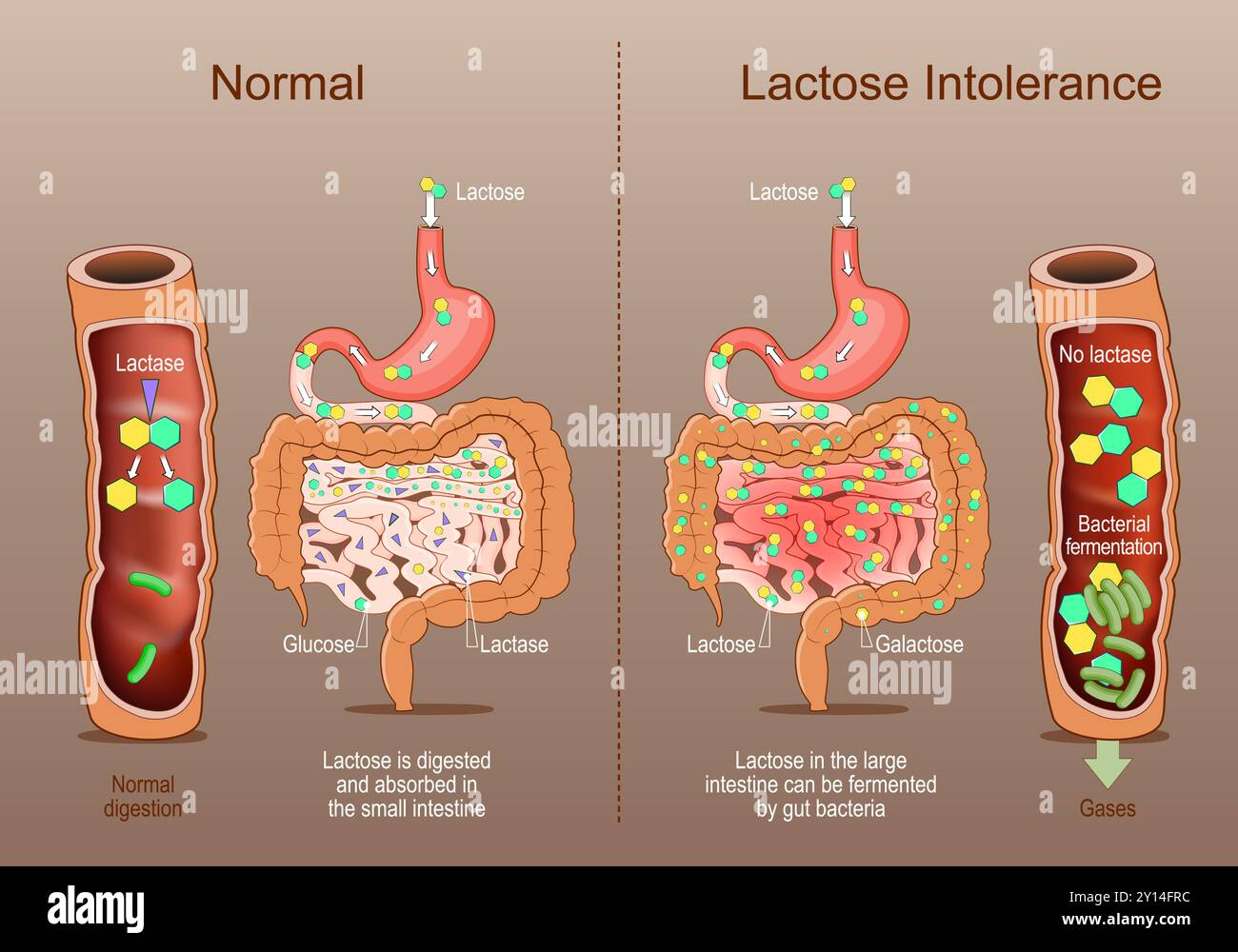 Intolleranza al lattosio. Sezione trasversale di un intestino umano con Lactase, glucosio, galattosio. Confronto della digestione normale quando viene digerito il lattosio Illustrazione Vettoriale