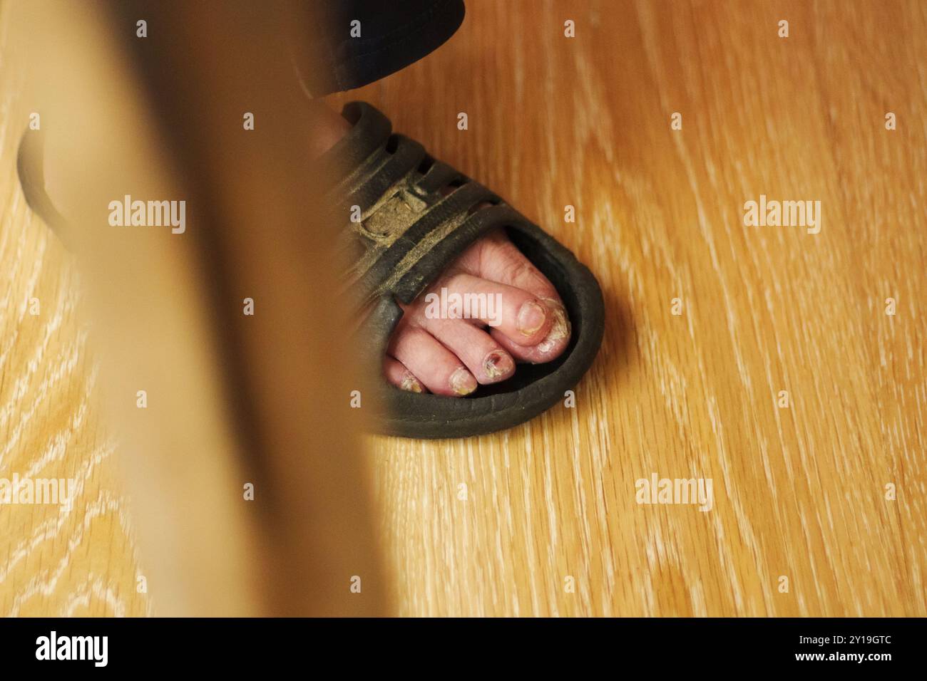 Primo piano di un piede con malattia visibile delle dita dei piedi mentre indossi un sandalo su pavimento in legno in interni Foto Stock