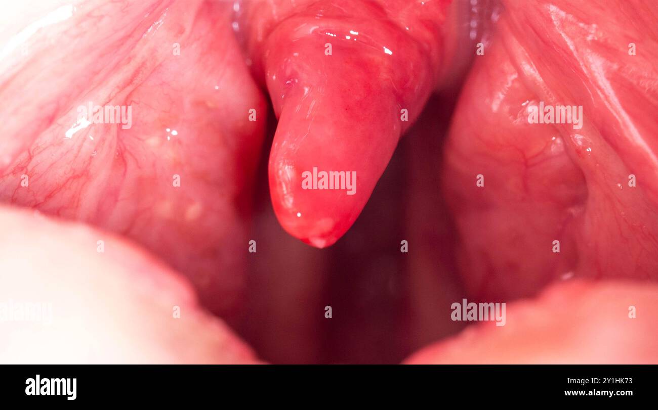 Uvula rossa, infiammata e gonfia in gola. Trattamento dell'uvulite dovuta a batteri e virus streptococcici. Otolaringologia Foto Stock