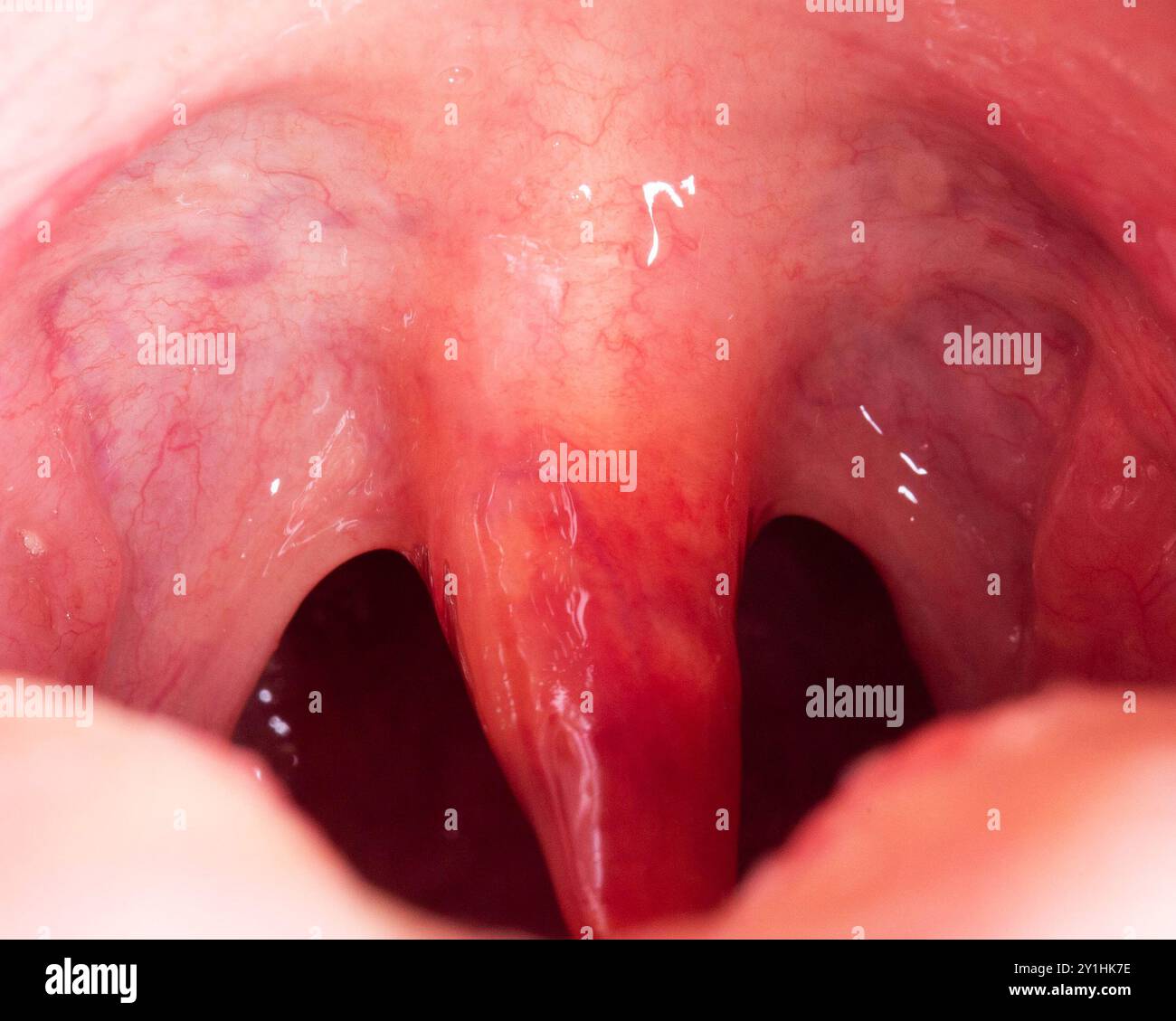 Uvula rossa, infiammata e gonfia in gola. Trattamento dell'uvulite dovuta a batteri e virus streptococcici. Otolaringologia Foto Stock