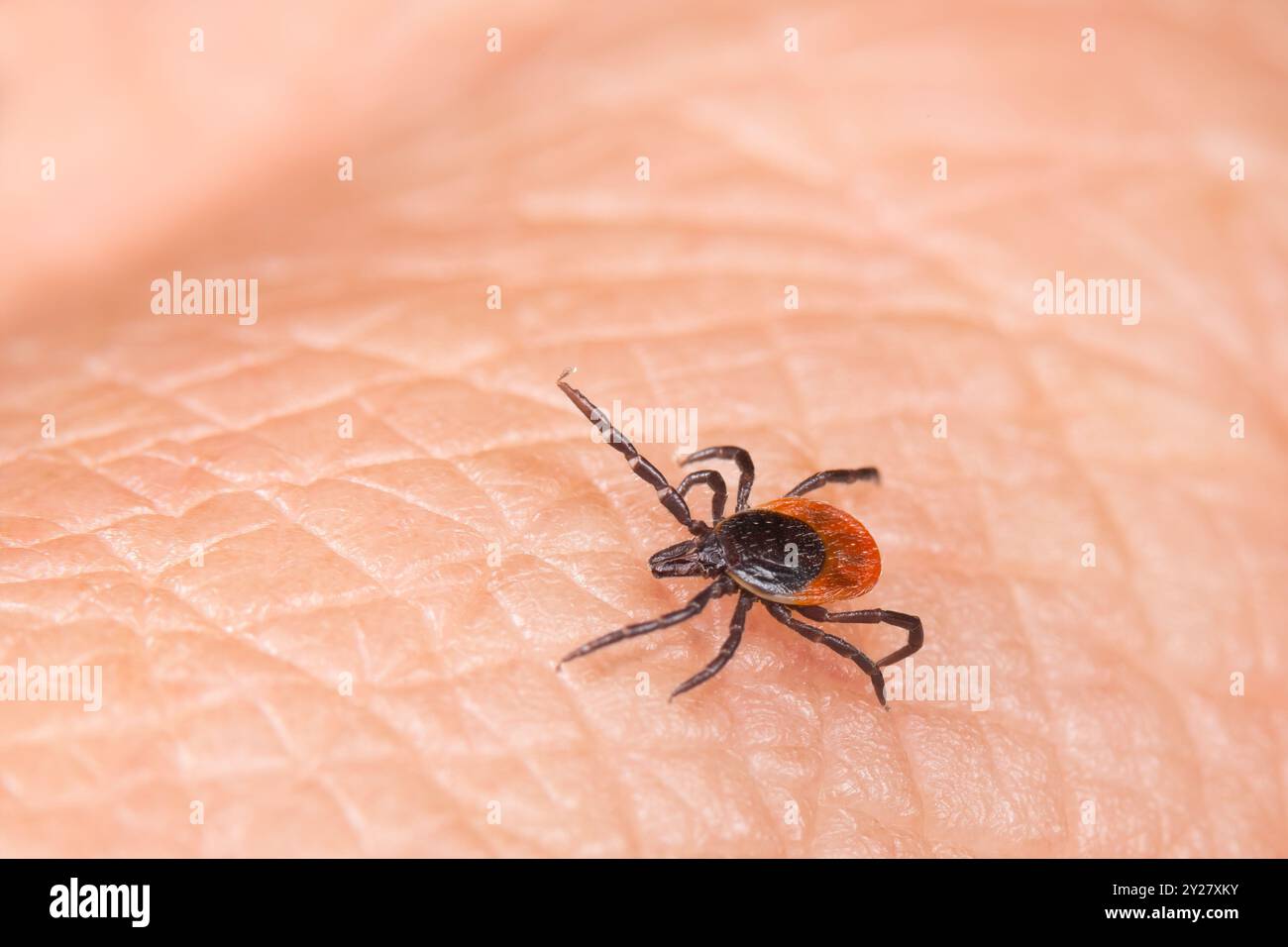 Zecche parassitarie di insetti acari, zecche nere o cervi su dettagli della pelle umana. Ixodi. Malattia di Lyme o encefalite da zecche pericolo di trasmissione. Foto Stock