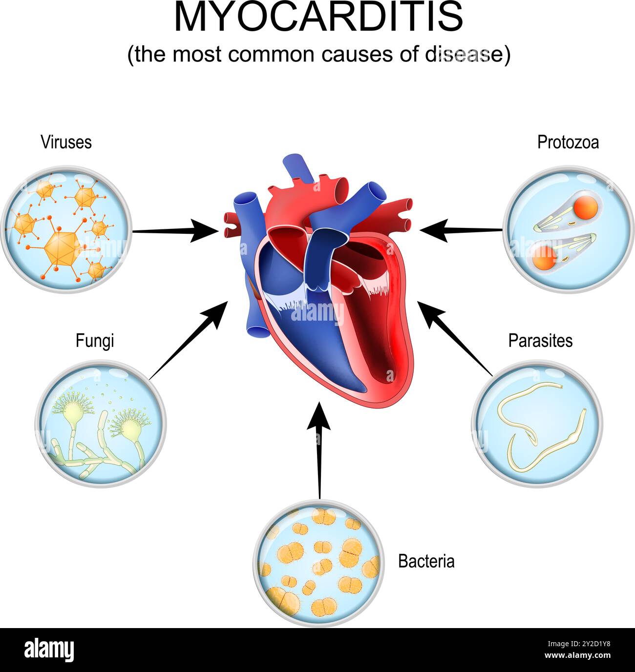 Miocardite. Sezione trasversale di un cuore umano e le cause più comuni di malattia come Protozoa, batteri, parassiti, funghi, virus. Illustrazione vettoriale Illustrazione Vettoriale