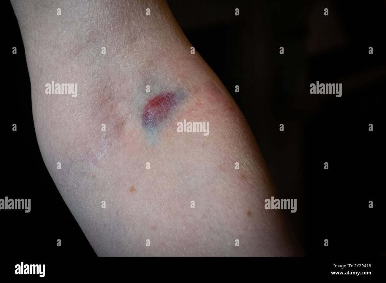 Ematoma venoso dopo un esame del sangue Foto Stock