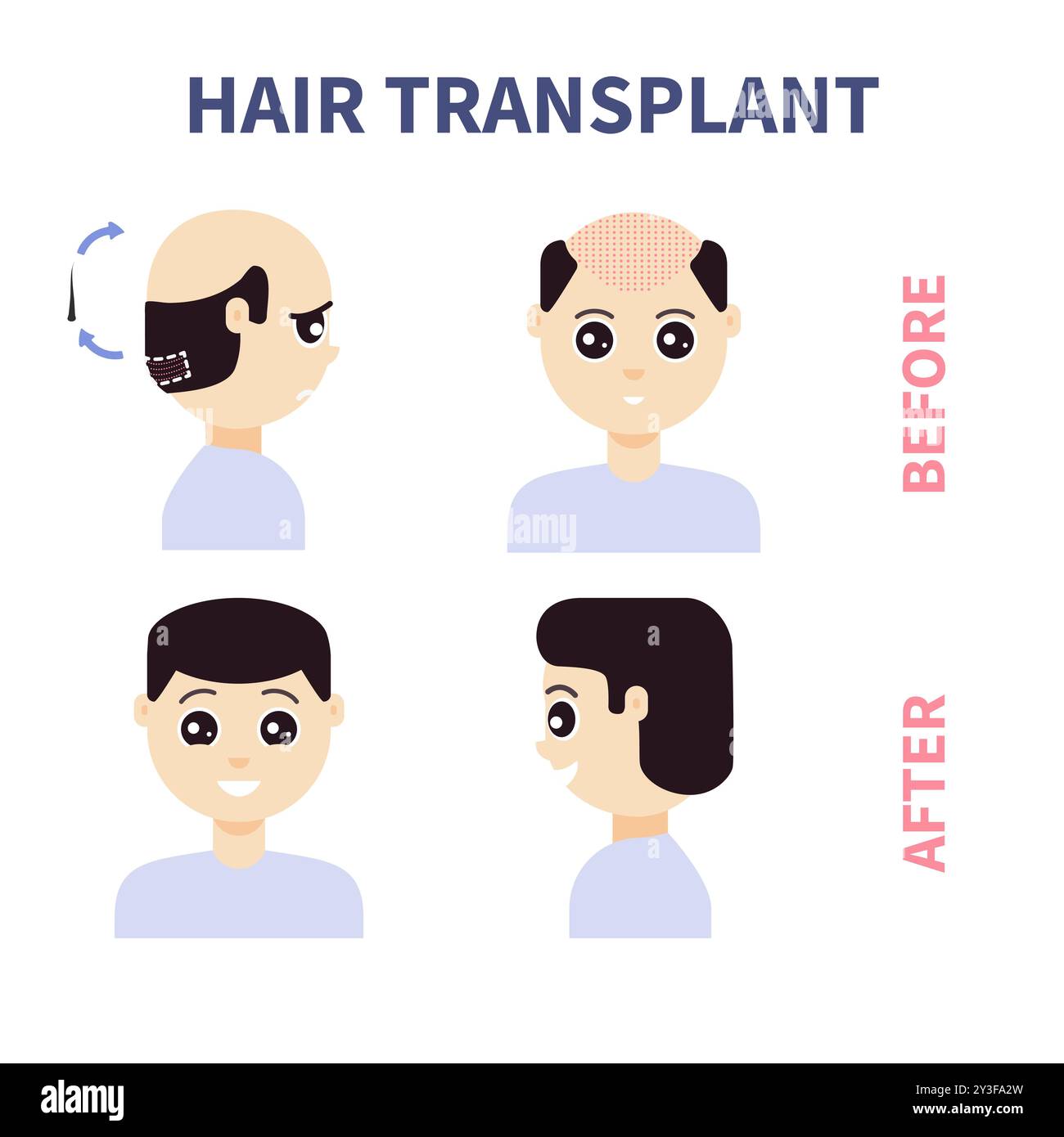 FUE trattamento di trapianto di capelli di alopecia illustrazione Illustrazione Vettoriale