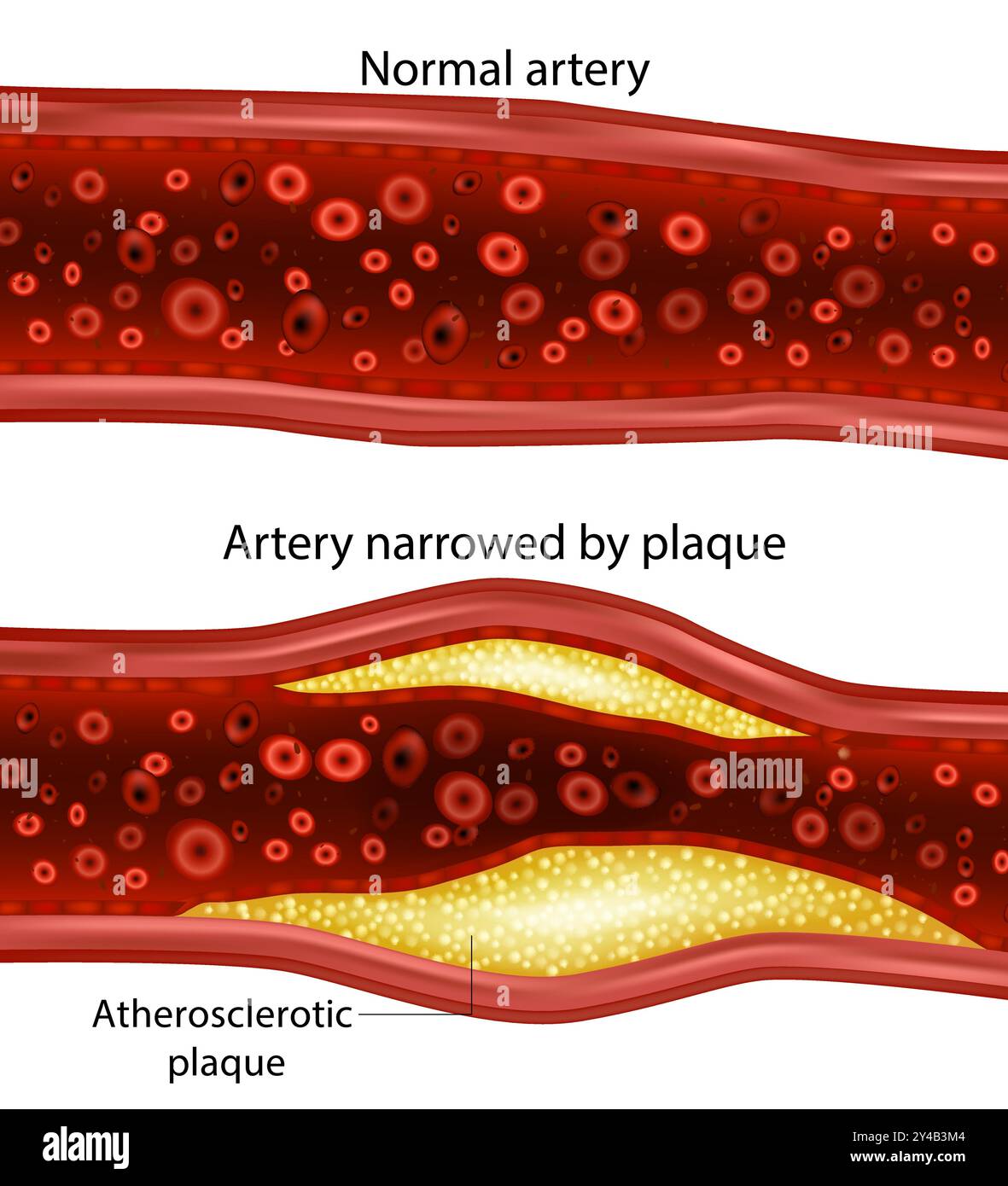 Placca di colesterolo nell'arteria. Arteria ristretta dalla placca e dall'arteria normale. Placca aterosclerotica. Illustrazione Vettoriale