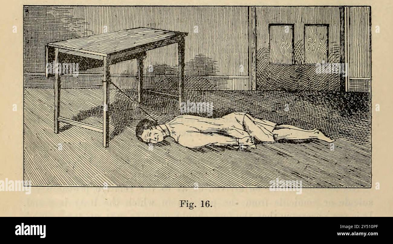 A impiccato man from Forensic medicine and Toxicology di Mann, J. Dixon (John Dixon), 1840-1912 data di pubblicazione 1898 pubblicato da Charles Griffin Foto Stock