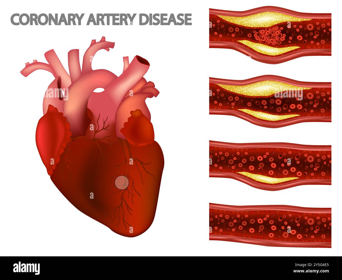 Coronaropatia e cardiopatia ischemica. Aterosclerosi in un'arteria coronaria. Malattie cardiovascolari. Riduzione del flusso sanguigno al cartoncino Illustrazione Vettoriale