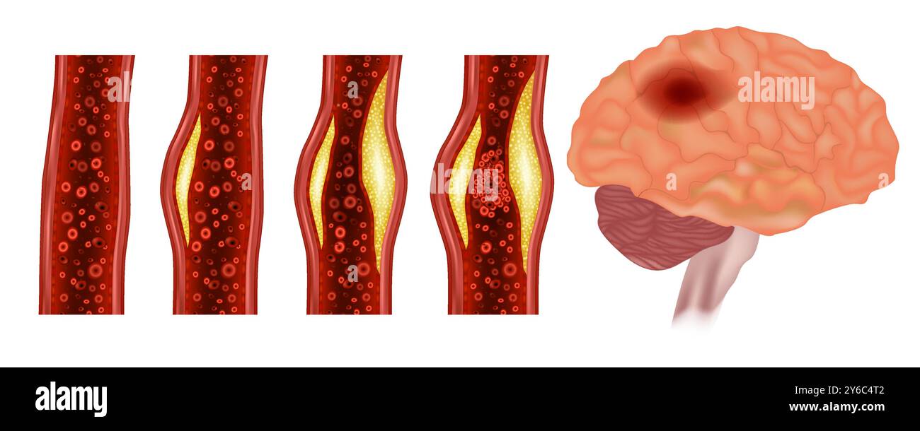Malattia da aterosclerosi intracranica. Arteria ristretta dalla placca e dall'arteria normale. Ictus o accidente cerebrovascolare o attacco cerebrale. Illustrazione Vettoriale
