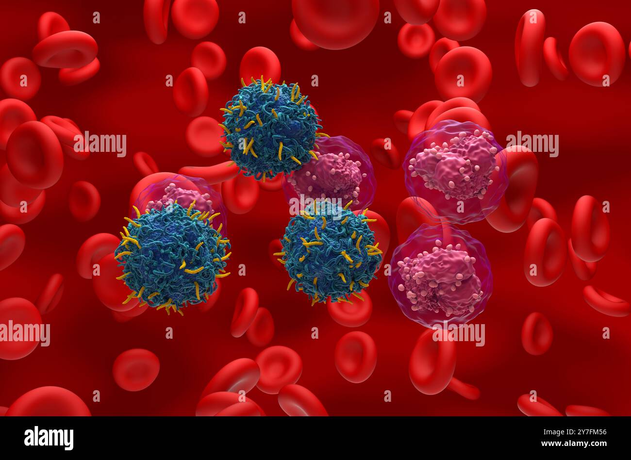 Terapia con cellule T di CAR nella leucemia linfocitica acuta (TUTTE) - Vista isometrica illustrazione 3d. Foto Stock