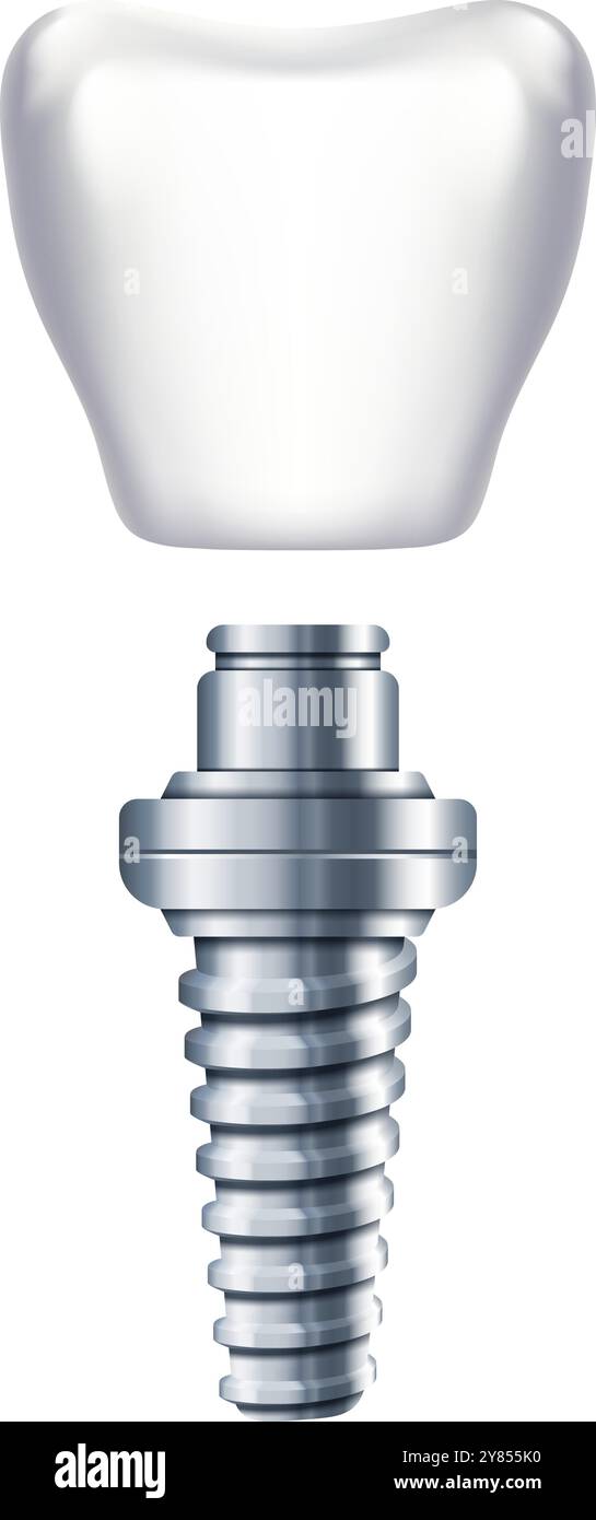 Schema di impianto dentale. Sostituzione dei denti. Illustrazione ortodontica Illustrazione Vettoriale