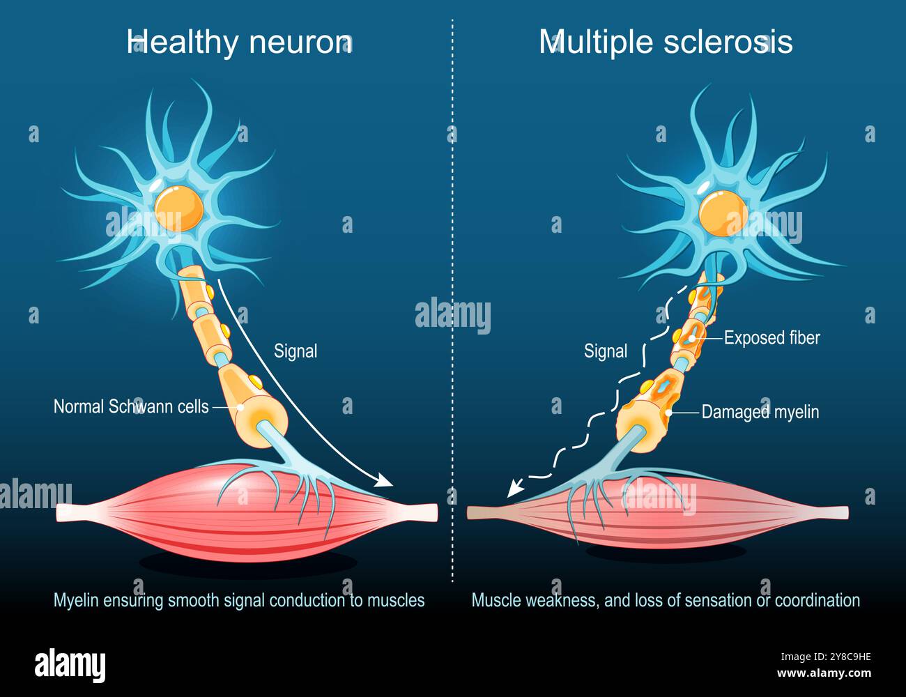 Sclerosi multipla. Mielina che assicura una regolare conduzione del segnale ai muscoli nei neuroni sani. Neurone sclerosi multipla con mielina danneggiata, fibo esposto Illustrazione Vettoriale