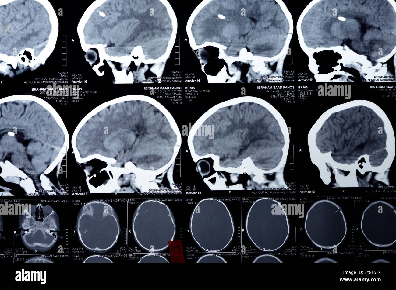 Cairo, Egitto, 17 settembre 2024: Brain CT scan rivela che il tubo di shunt sinistro termina nel ventricolo laterale destro, senza dilatazione ventricolare residua Foto Stock