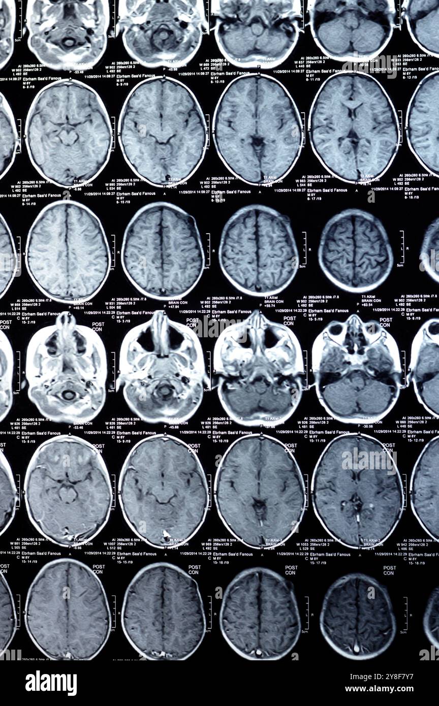 Cairo, Egitto, settembre 26 2024: MRI Brain rivela il funzionamento del drenaggio intra-ventricolare dello shunt, piccola area focale di cambiamenti gliotici nel peritr profondo destro Foto Stock