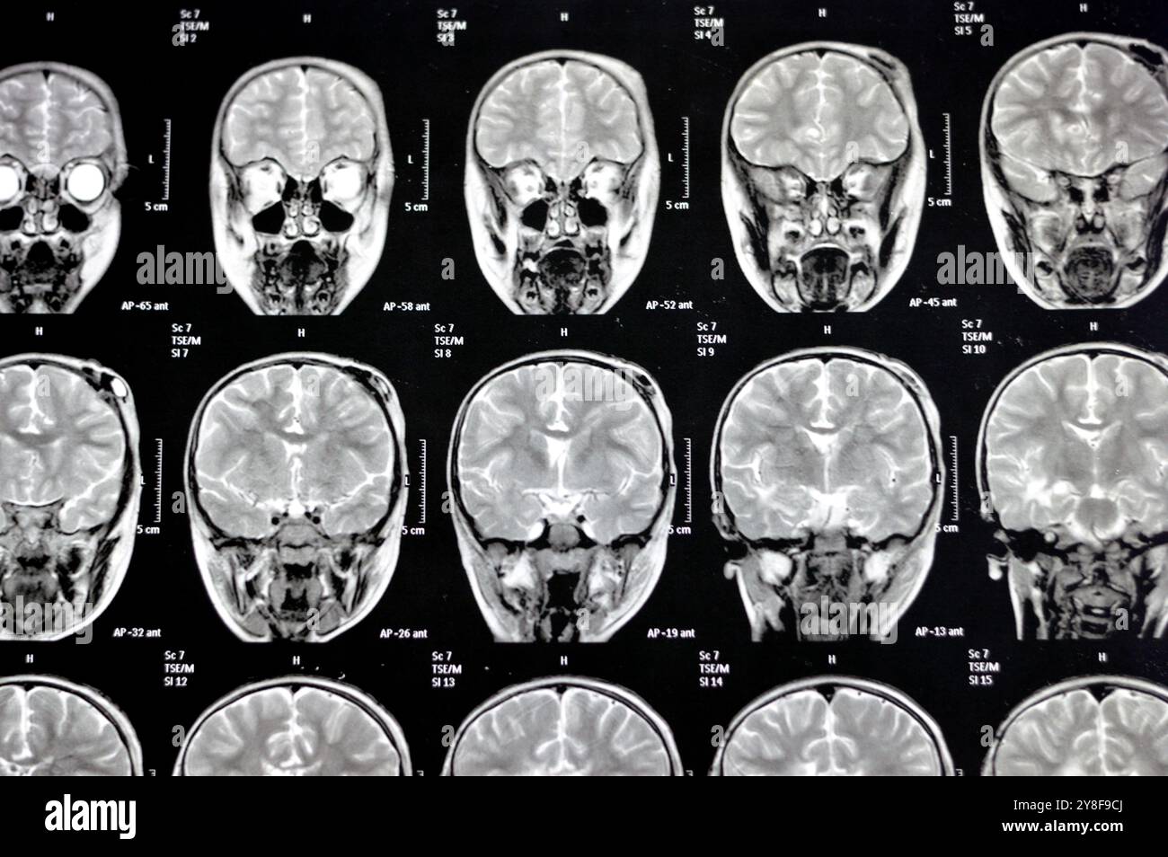 La risonanza magnetica del cervello rivela precedenti operazioni di shunt per un caso di idrocefalo, lesione para-falcina pre-ventricolare anteriore destra che migliora la lesione con il sospetto Foto Stock