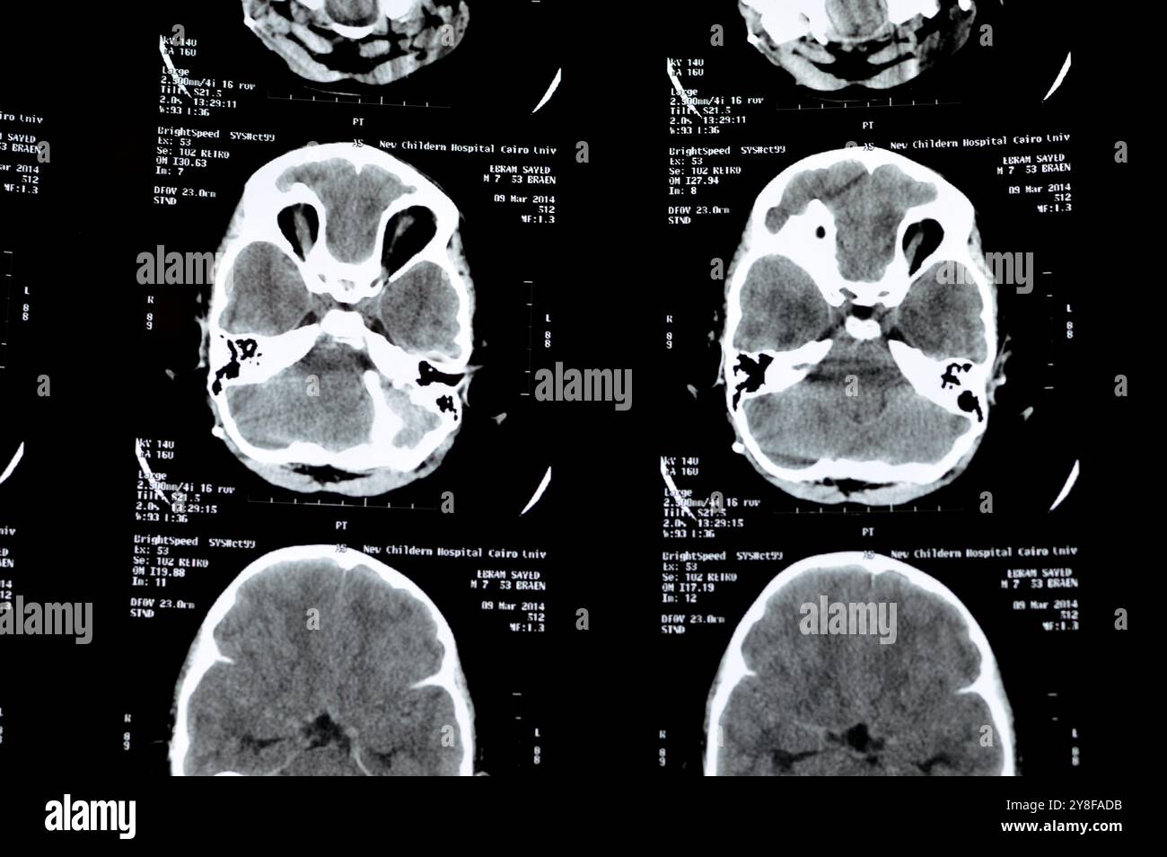 Cairo, Egitto, settembre 26 2024: Post inserimento del tubo di shunt laterale destro, sistema ventricolare supratentoriale dilatato, sospetto lesione di massa del tessuto molle u Foto Stock
