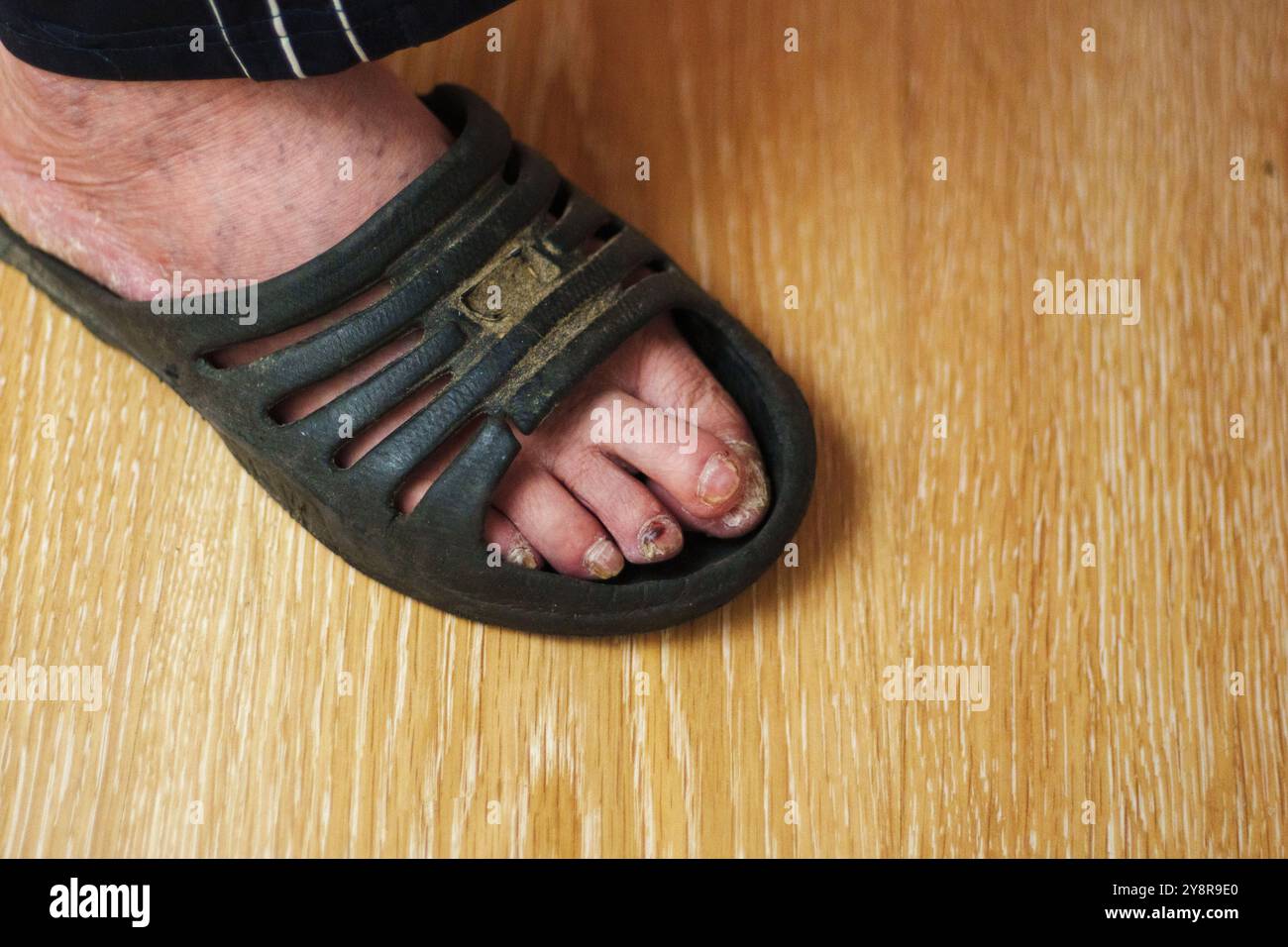 Primo piano di un piede con malattia visibile delle dita dei piedi mentre indossi un sandalo su pavimento in legno in interni Foto Stock