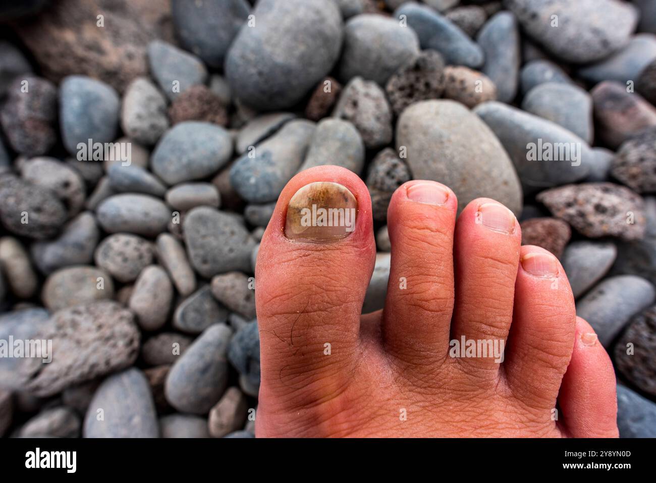 unghia destra a punta grossa annerita da una schiacciata e dalle scarpe strette di un sentiero di un uomo adulto con sfondo di pietre vulcaniche Foto Stock