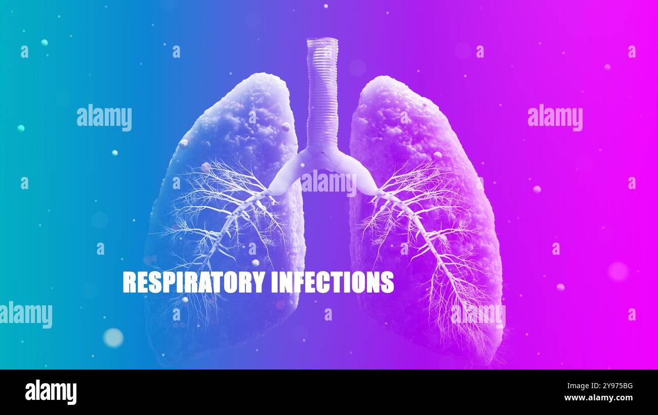 Polmoni umani con infezione si diffondono all'interno dell'innovazione e della tecnologia medica. RSV, sintomi da virus sinciziale Foto Stock