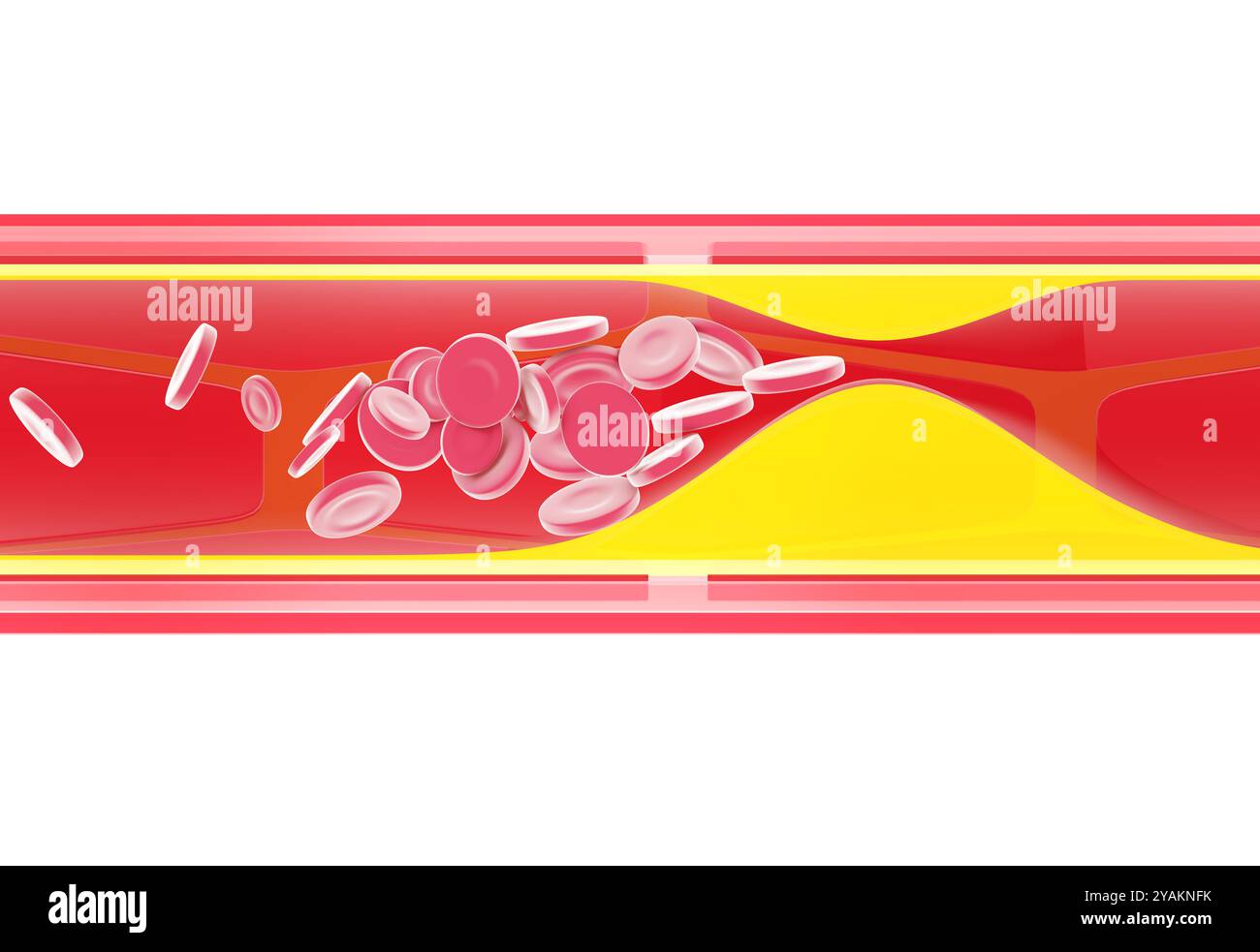 Illustrazione 3D anatomica dell'interno di un'arteria che mostra gli strati che la formano. Ostruito dall'accumulo di grasso. Foto Stock