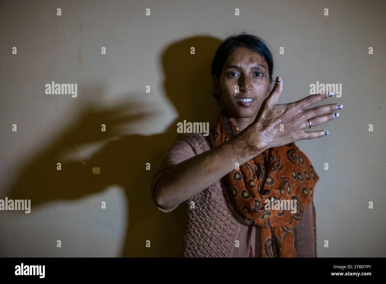 India, Calcutta, donne vittime attacco acido, ritratto Foto Stock