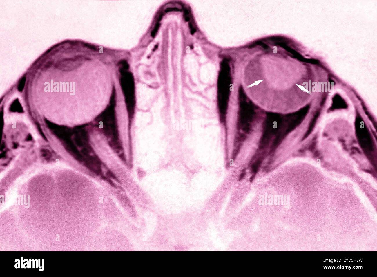 Il distacco della retina si verifica quando il tessuto nella parte posteriore dell'occhio si stacca dallo strato dei vasi sanguigni che forniscono ossigeno all'occhio. Foto Stock