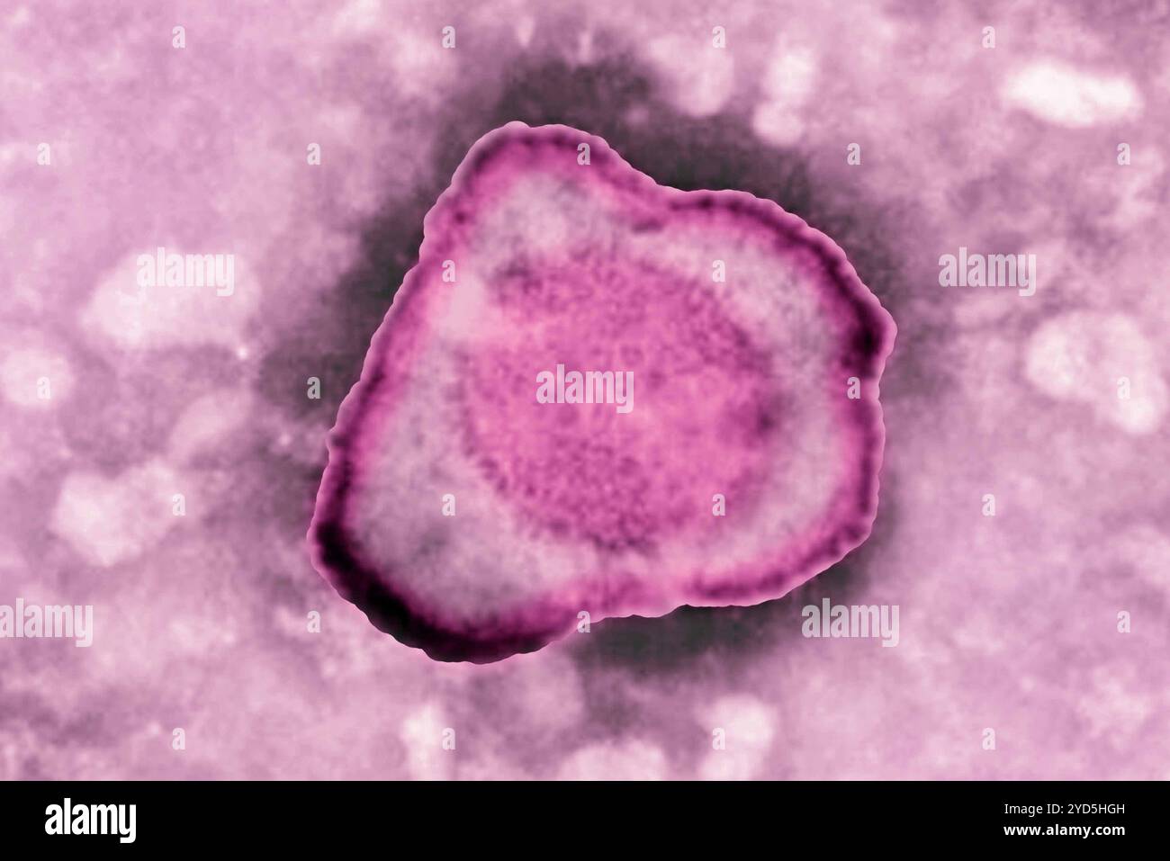 Herpes virus (HSV. HSV è la causa di herpes labiale, herpes genitale, varicella, mononucleosi infettiva, roseola, a volte il herpes zoster. Foto Stock