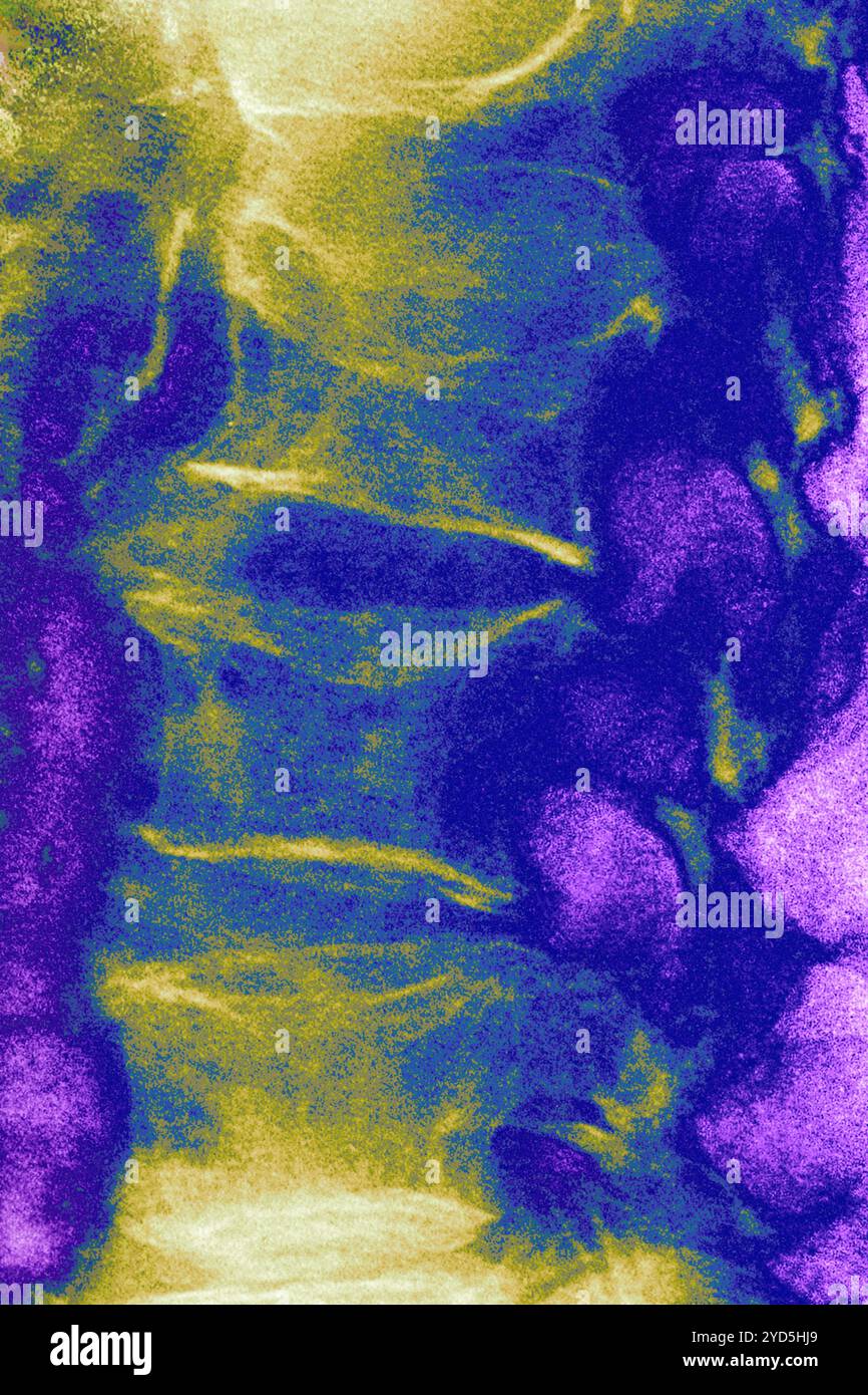 Osteoporosi lombare (malattia che causa compressione e fratture delle vertebre lombari). Radiografia delle vertebre lombari vista dalla parte anteriore. Foto Stock