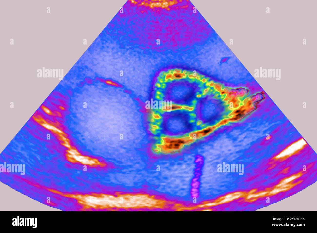 Valvola tricuspide, separa l'atrio destro e il ventricolo. È composto da tre fogli o (cusps). Foto Stock