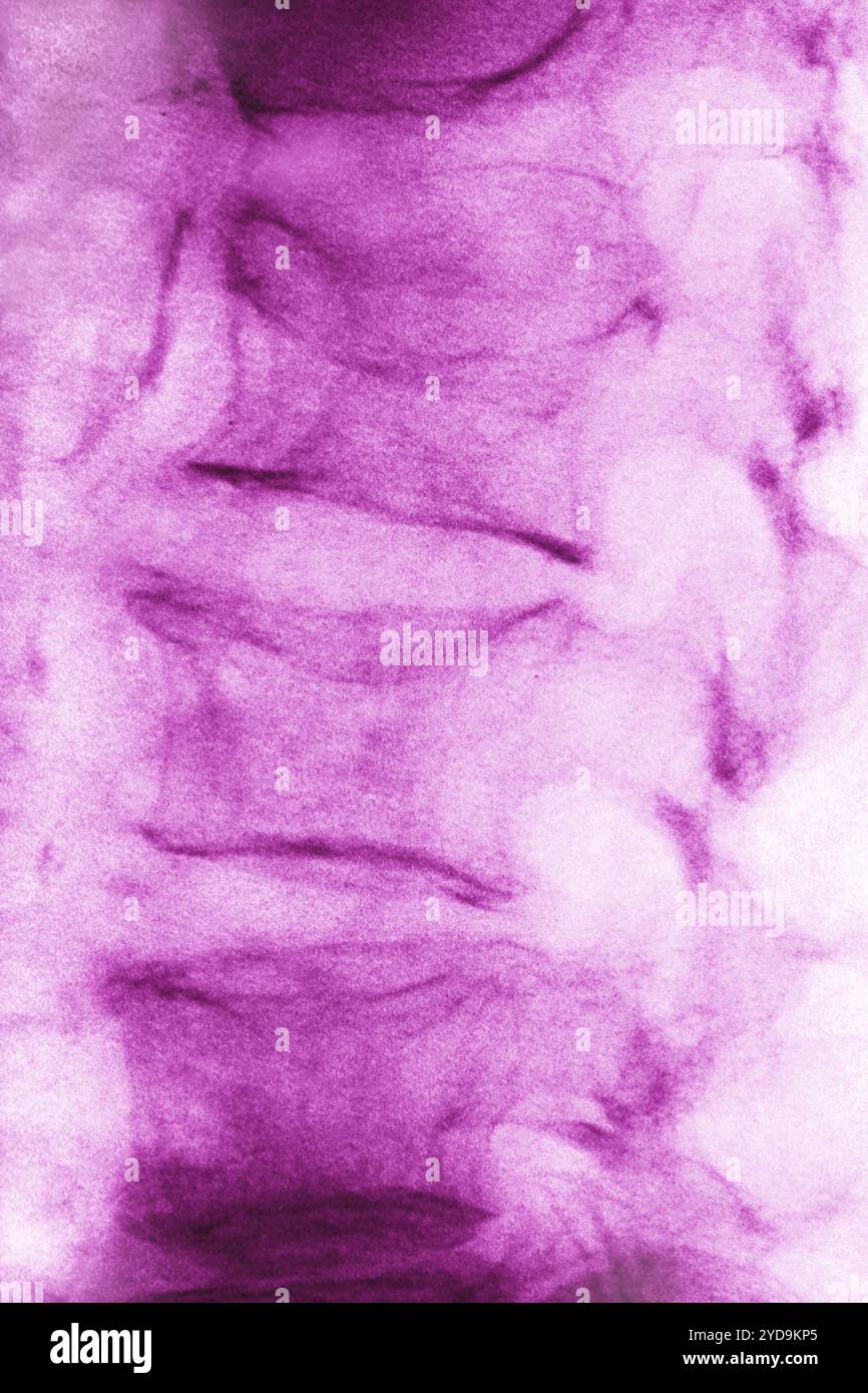 Malattia da osteoporosi lombare che causa compressione e fratture delle vertebre lombari. Radiografia delle vertebre lombari vista dalla parte anteriore. Osteoporosi lombare. 016836_035 Foto Stock