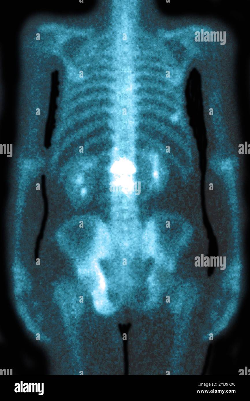 Malattia da osteoporosi lombare che causa compressione e fratture delle vertebre lombari. Radiografia delle vertebre lombari vista dalla parte anteriore. Osteoporosi lombare. 016836_038 Foto Stock