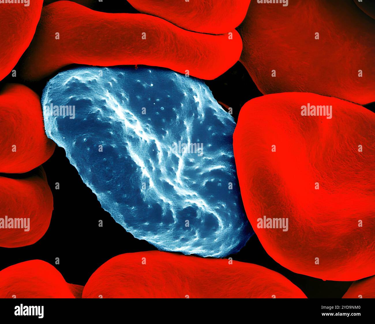 Micrografia elettronica a scansione colorata di globuli rossi infettati da parassiti della malaria blu. I piccoli dossi sulla cellula infetta mostrano come il parassita ristruttura la sua cellula ospite formando protrusioni chiamate manopole sulla superficie, consentendo di evitare la distruzione e causare infiammazione. I globuli rossi non infetti hanno superfici più lisce. Eritrociti infettati da parassiti della malaria 016867 017 Foto Stock