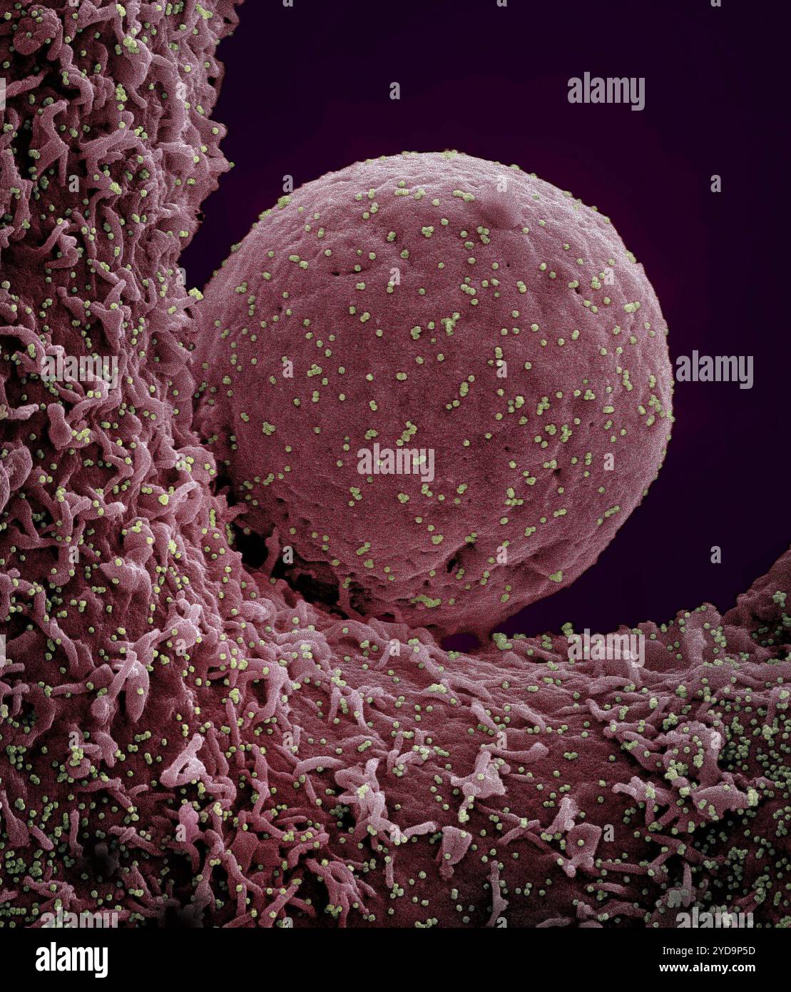 Micrografia elettronica a scansione colorata di una cellula rossa infettata dal ceppo Omicron di particelle di virus SARS-CoV-2 giallo-verde, isolata da un campione paziente. Nuovo Coronavirus SARS-CoV-2 Omicron 016867_050 Foto Stock