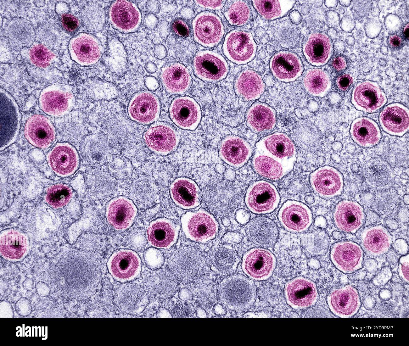 Micrografia elettronica di trasmissione di particelle CMV citomegalovirus rosa trovato all'interno delle vescicole intracellulari di un macrofago infetto viola. Particelle CMV del citomegalovirus 016867 093 Foto Stock