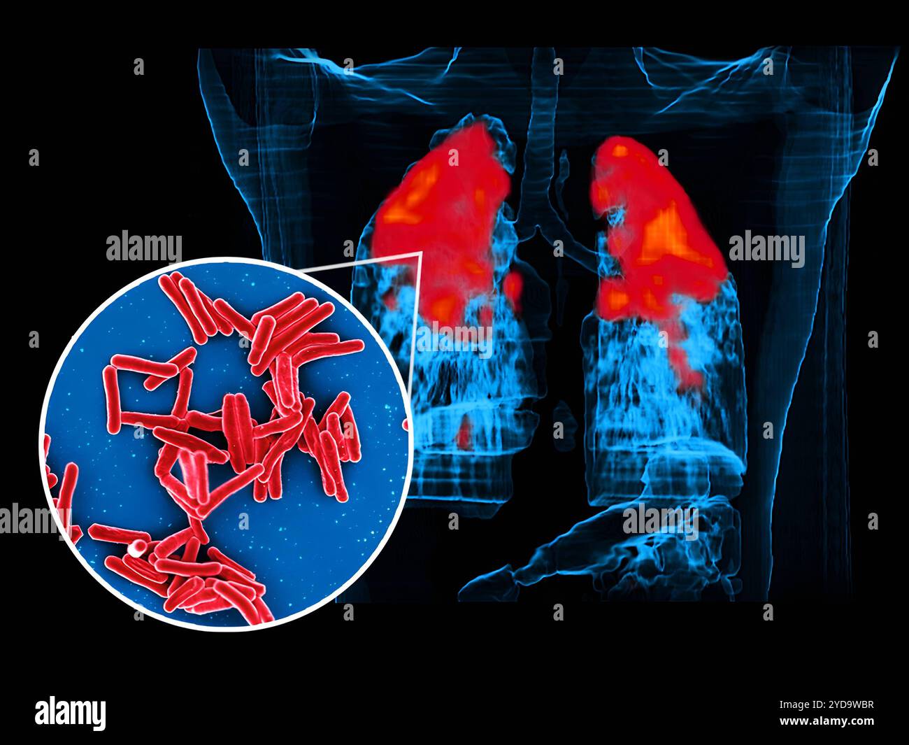 La micrografia elettronica a scansione dei batteri Mycobacterium tuberculosis, che causano la TB, i batteri dell'immagine circolare in primo piano sono colorati in rosso e una scansione PET/TC mostra l'infezione da TB in rosso nell'immagine di sfondo dei polmoni del paziente. Batteri Mycobacterium tuberculosis, la causa della TB 016867 402 Foto Stock
