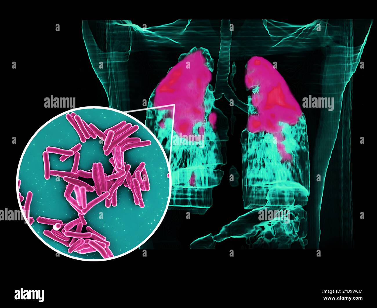 La micrografia elettronica a scansione dei batteri Mycobacterium tuberculosis, che causano la TB, i batteri dell'immagine circolare in primo piano sono colorati di rosa e una scansione PET/TC mostra l'infezione da TB di rosa nell'immagine di sfondo polmonare di un paziente. Batteri Mycobacterium tuberculosis, la causa della TB 016867 403 Foto Stock