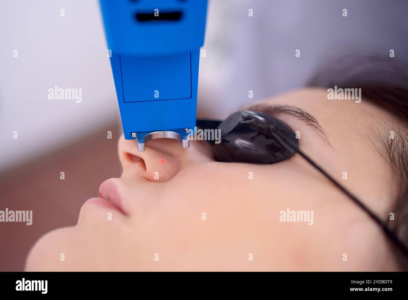 Primo piano del viso di una donna con gli occhiali e un dispositivo per rimuovere i punti neri dalla pelle. Trattamento della pigmentazione, della rosacea e. Foto Stock