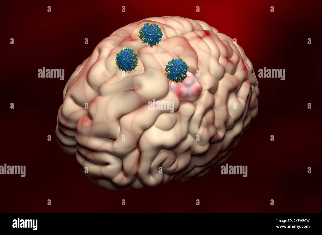 Terapia con cellule T di CAR nel meningioma - Vista isometrica con illustrazione 3d. Foto Stock