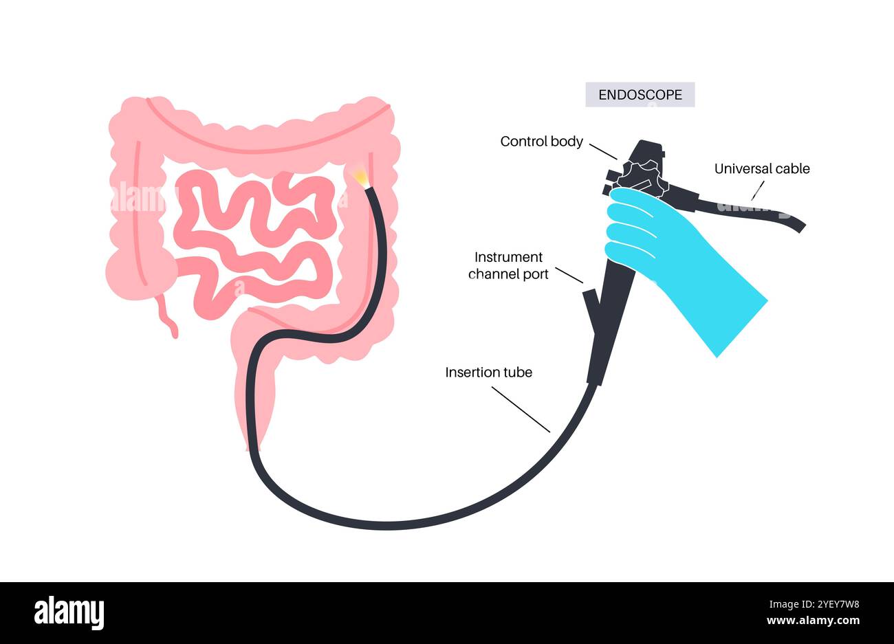 Illustrazione concettuale di una procedura di colonscopia. Questo è un esame dell'interno del vostro intestino crasso, che comprende il colon, il retto e l'ano. Può essere utilizzato per esplorare le possibili cause di dolore addominale, sanguinamento rettale, diarrea cronica e altri problemi gastrointestinali. Viene utilizzato anche per cercare possibili segni di cancro colorettale o polipi. Foto Stock
