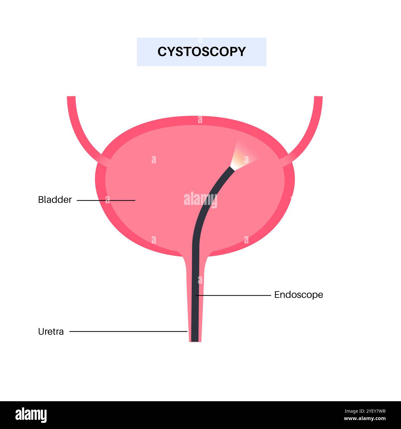 Illustrazione concettuale di una procedura di cistoscopia. Si tratta di una procedura utilizzata per diagnosticare, monitorare e trattare le condizioni che interessano la vescica e l'uretra. Foto Stock