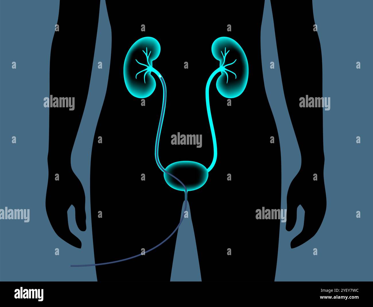Illustrazione concettuale di una procedura ureteroscopica. Si tratta di una procedura eseguita per esaminare o trattare problemi nel tratto urinario, come i calcoli renali. Foto Stock